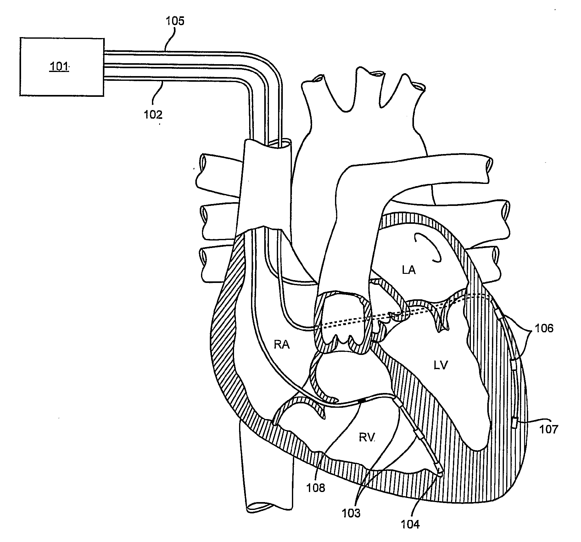 Automated Optimization of Multi-Electrode Pacing for Cardiac Resynchronization