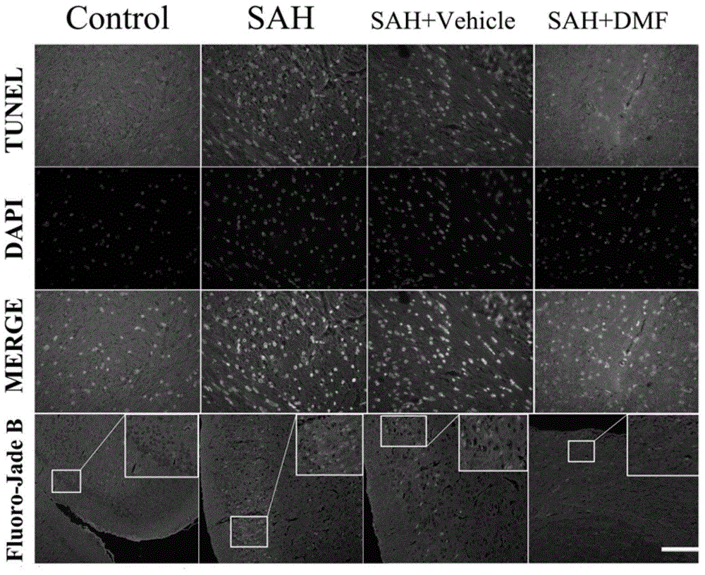 Application of dimethyl fumarate in the preparation of drugs for treating early brain injury after subarachnoid hemorrhage