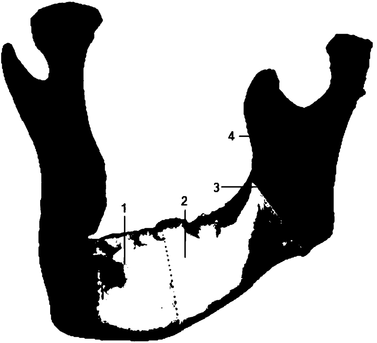 Lower jawbone position information recording method based on guide plate