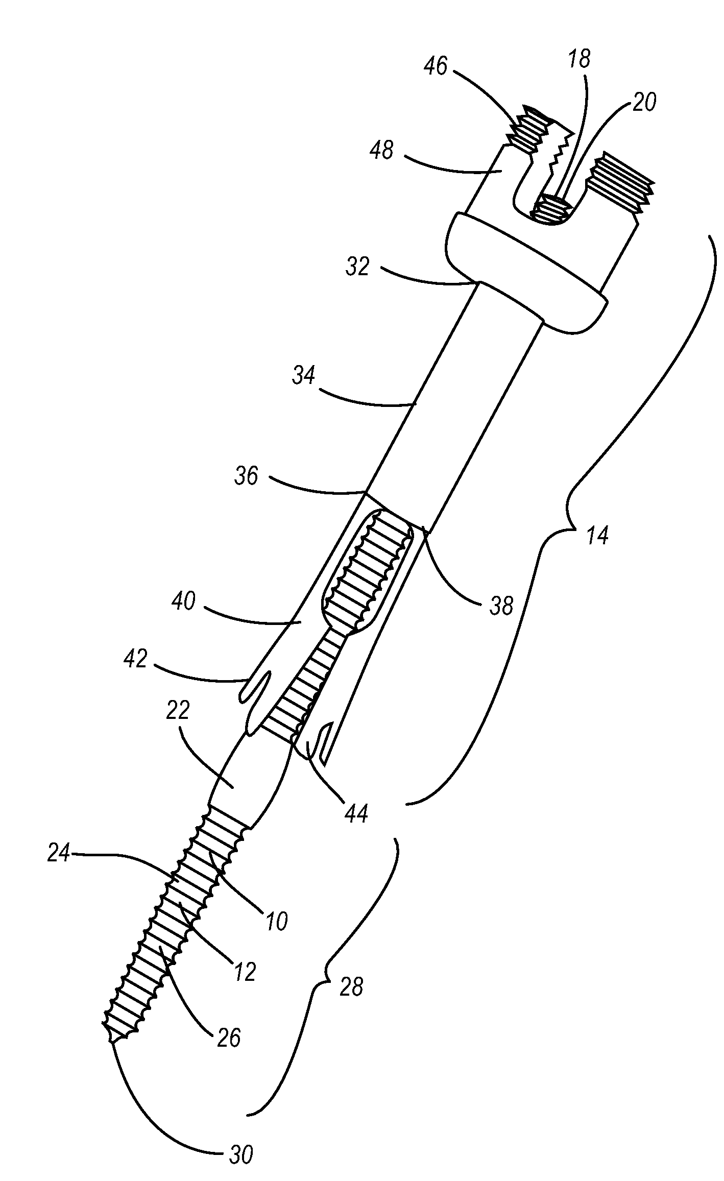 Osteoporatic screw and expansion sleeve