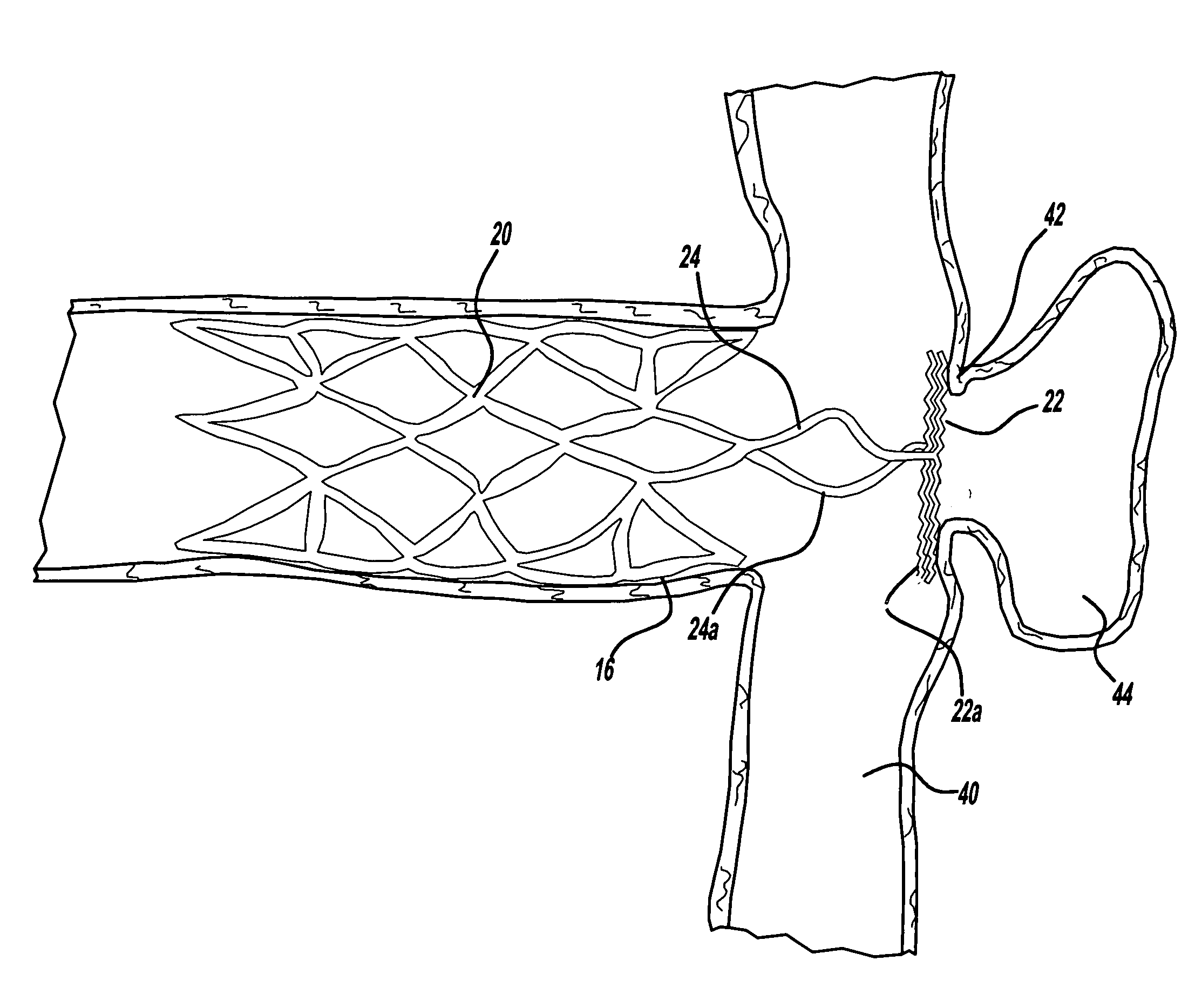 Neck covering device for an aneurysm