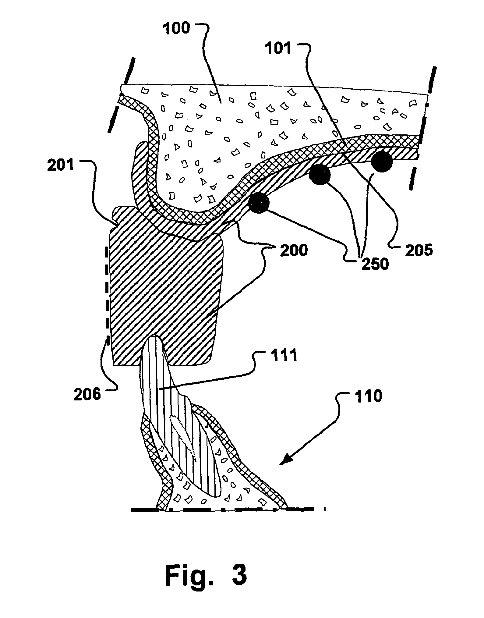 System and method for planning a first and second dental restoration