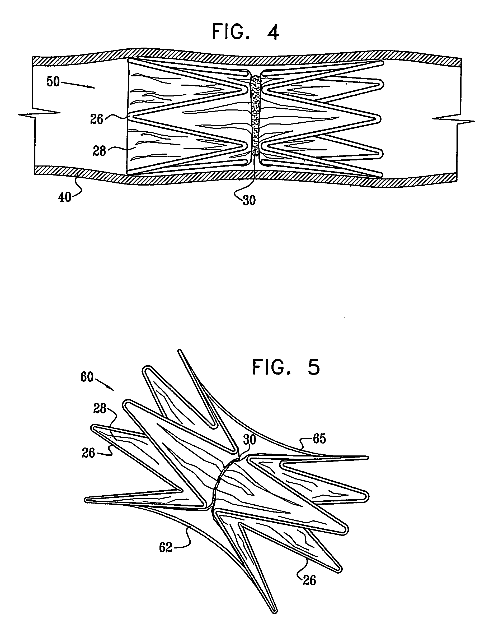 Vascular implant