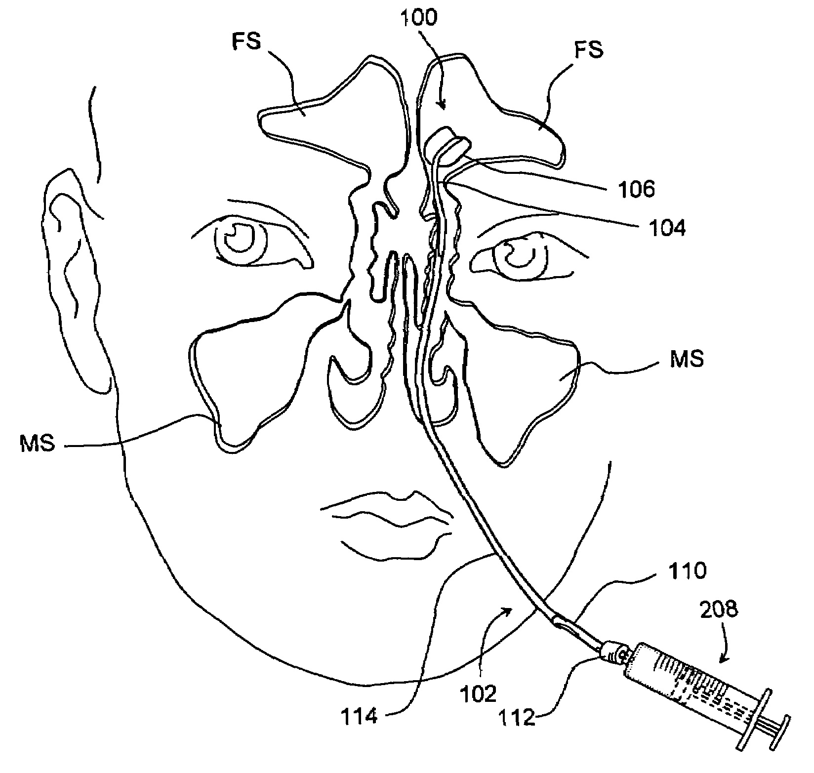 Devices and methods for delivering therapeutic substances for the treatment of sinusitis and other disorders