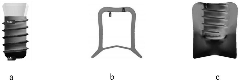 Implant structure optimization method based on finite element model