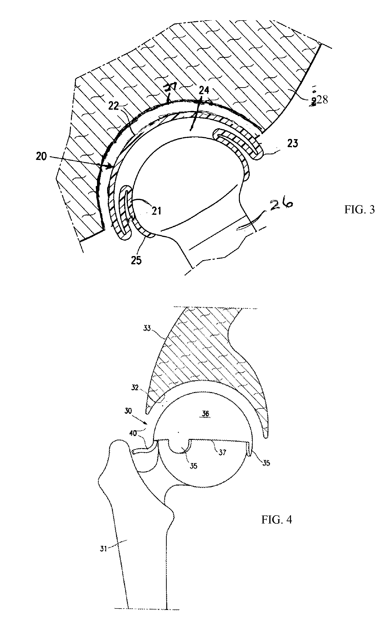 Resilient interpositional hip arthroplasty device