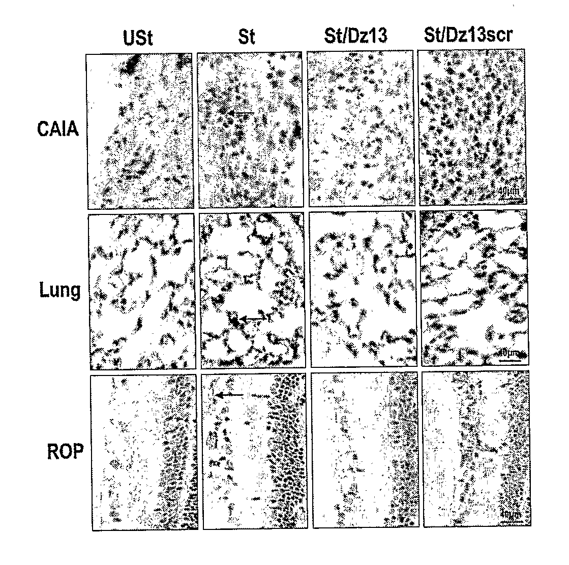 Treatment of rheumatoid arthritis