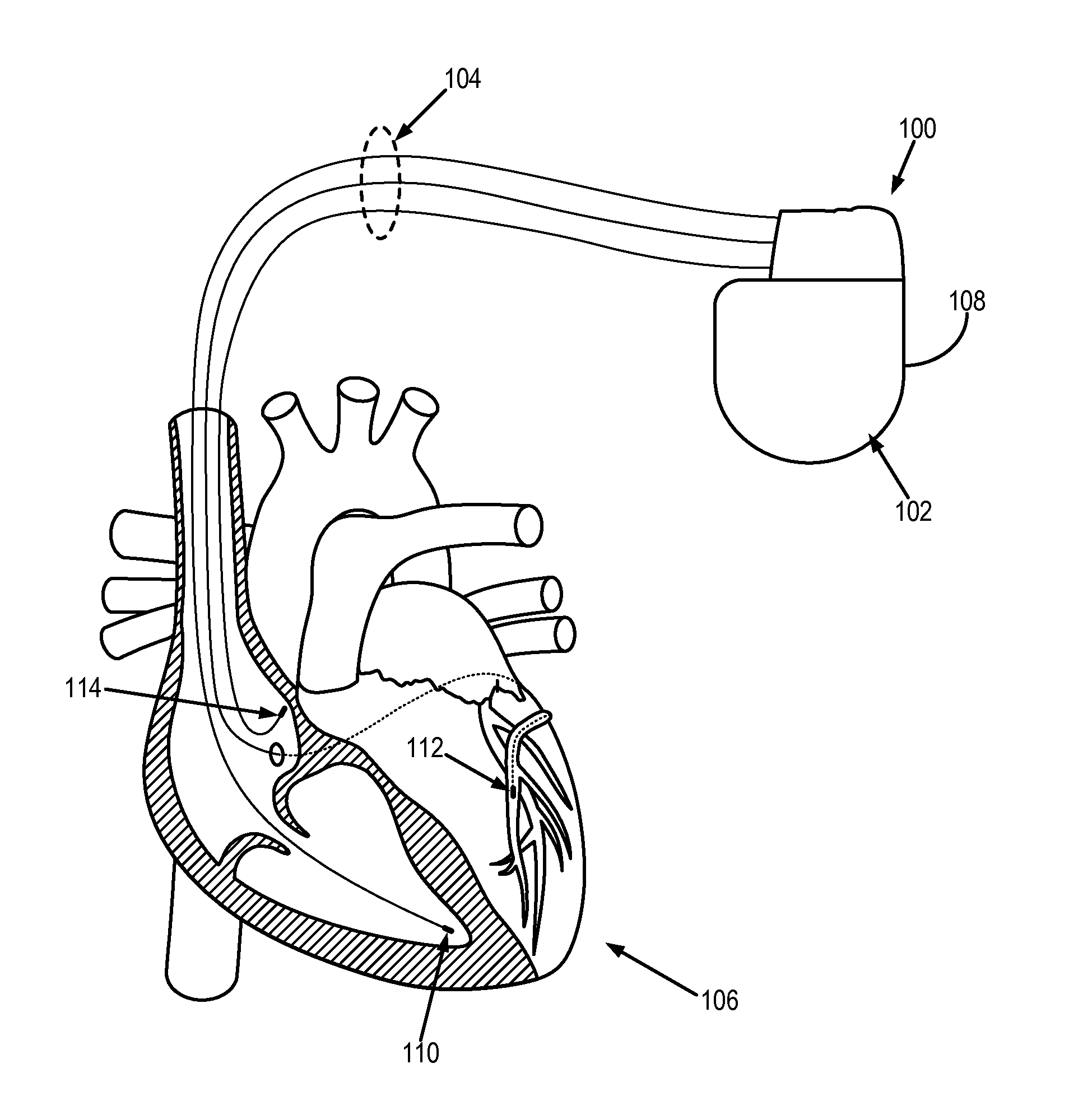 System and method for automated adjustment of cardiac resynchronization therapy control parameters