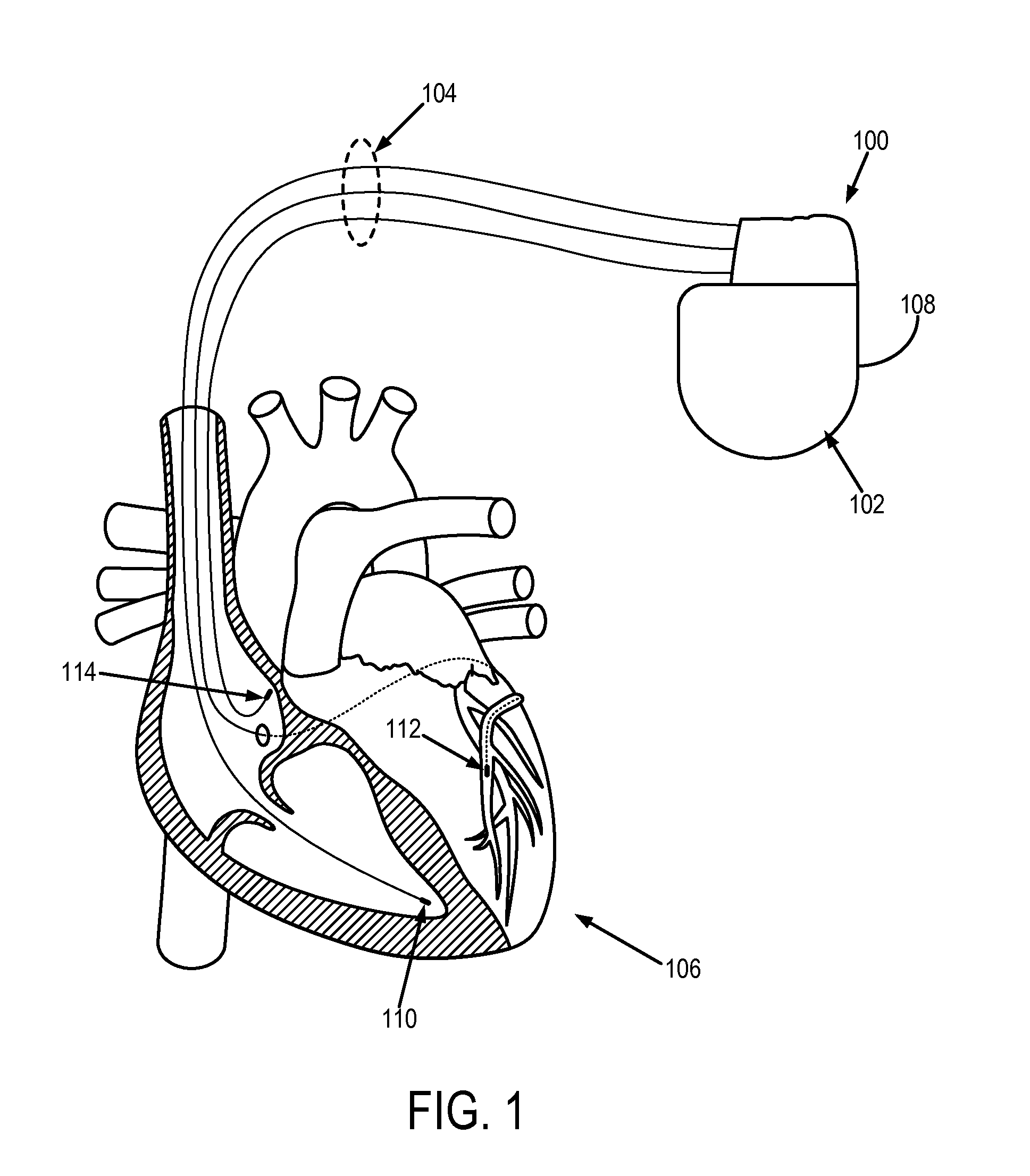 System and method for automated adjustment of cardiac resynchronization therapy control parameters