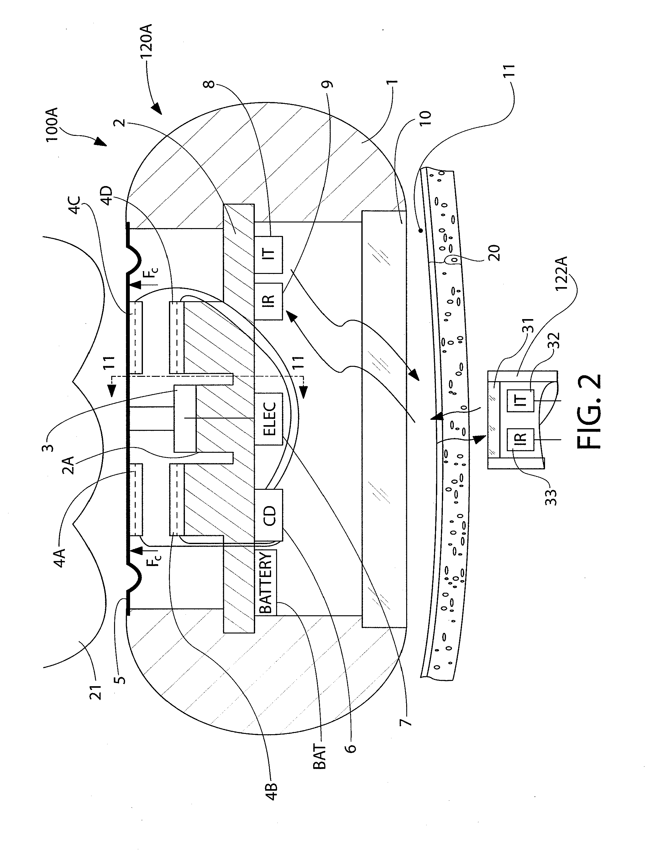 Implantable pressure sensor