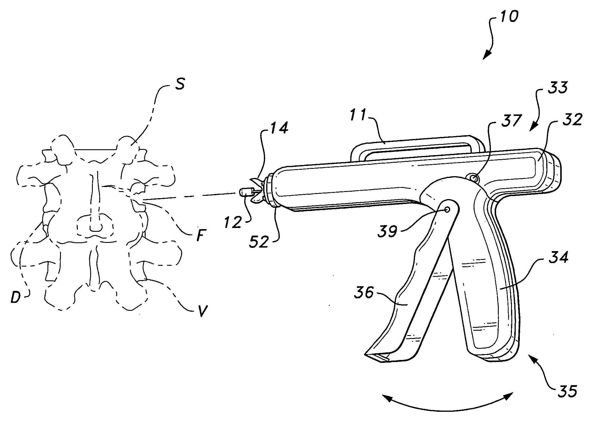 Bioinjection device