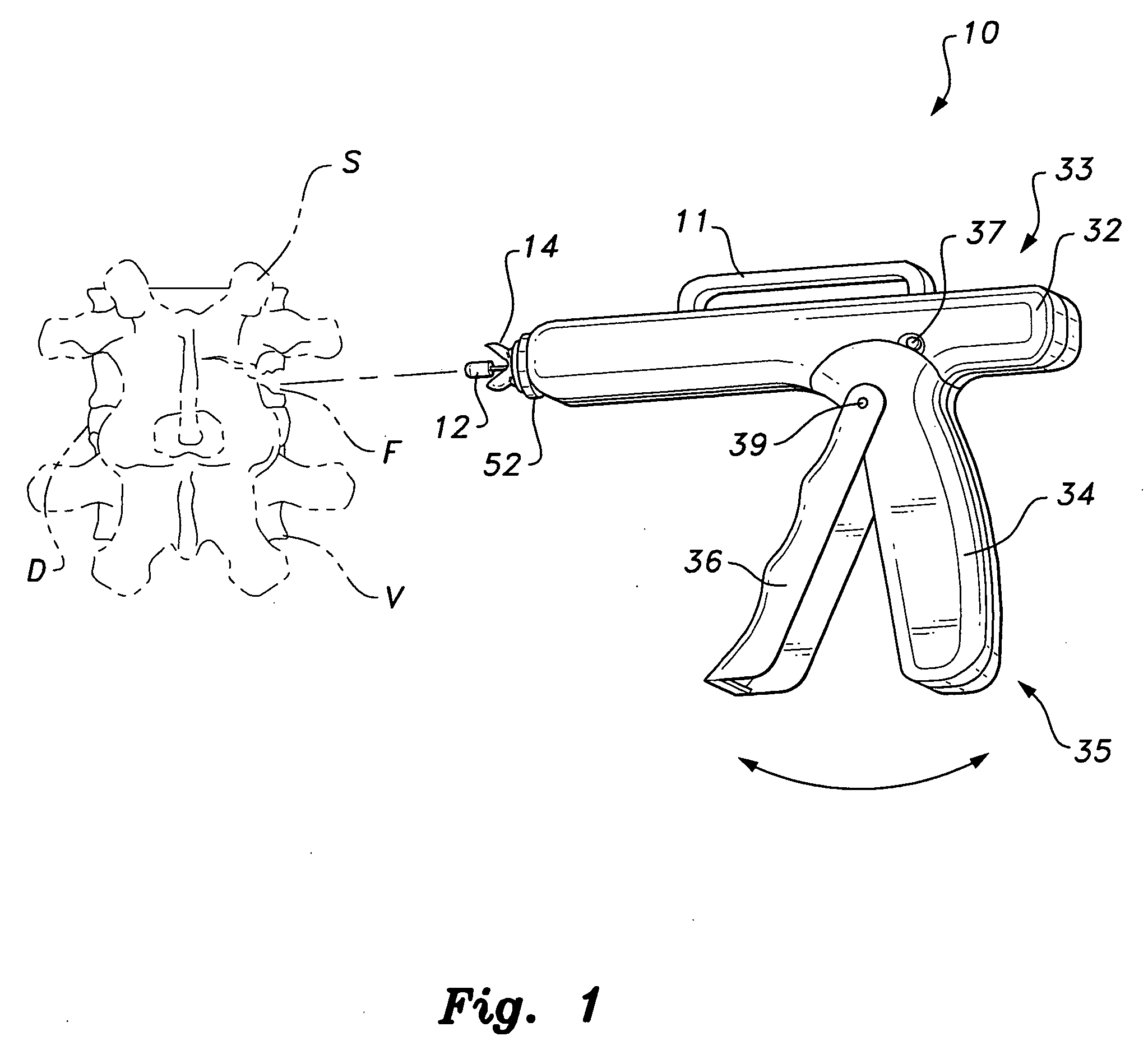 Bioinjection device