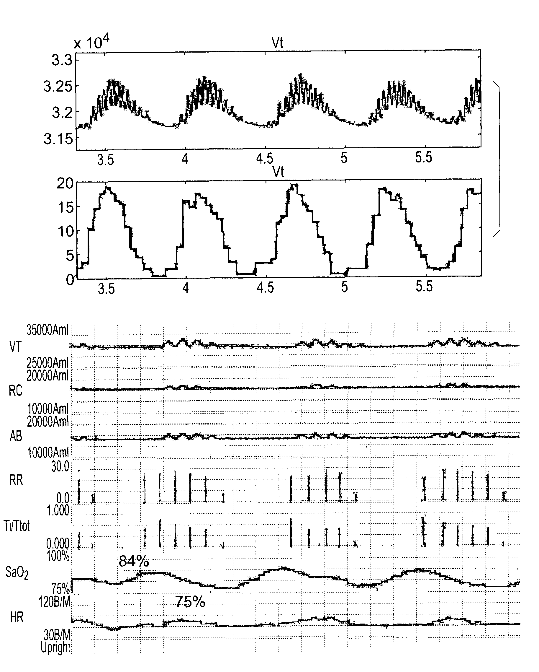 Automatic and ambulatory monitoring of congestive heart failure patients