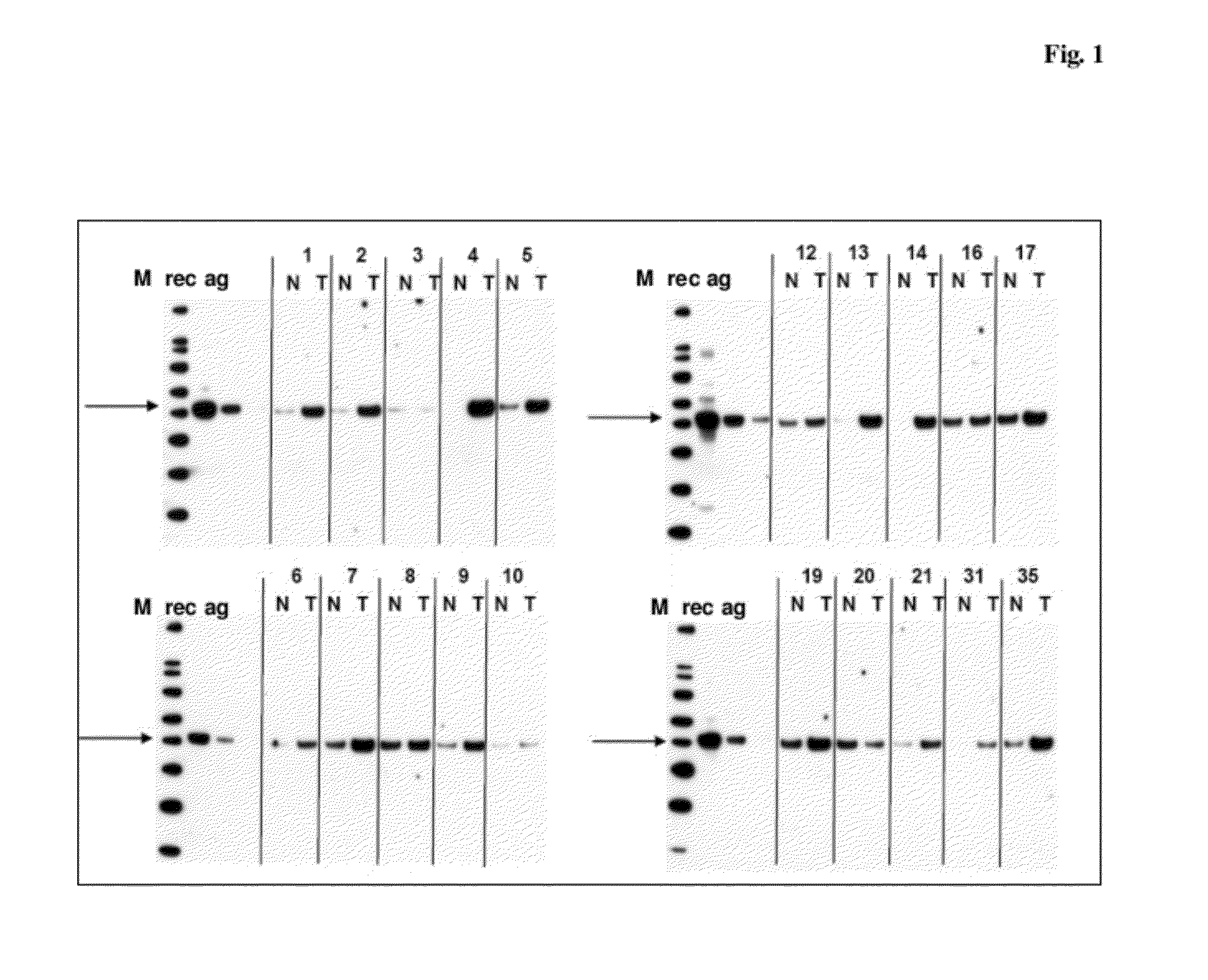 Secernin-1 as a marker for cancer