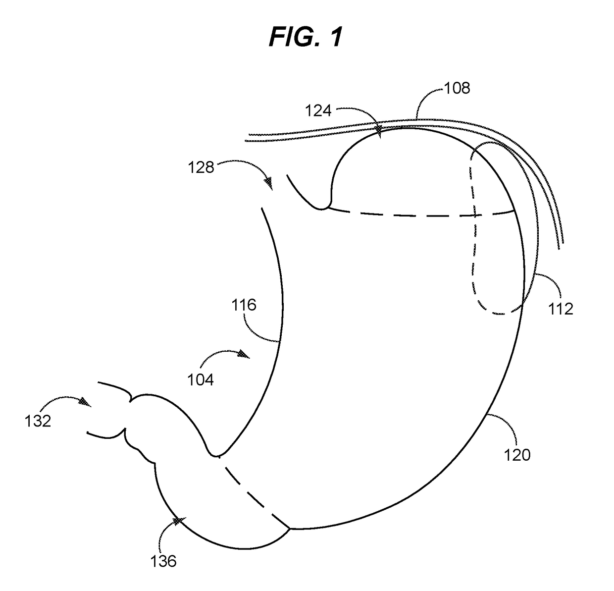 Safe sleeve gastrectomy