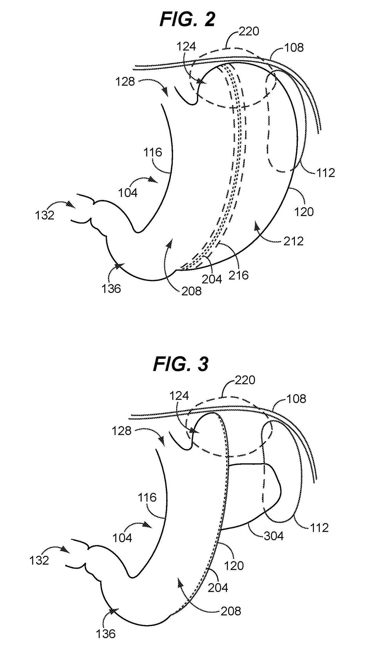 Safe sleeve gastrectomy