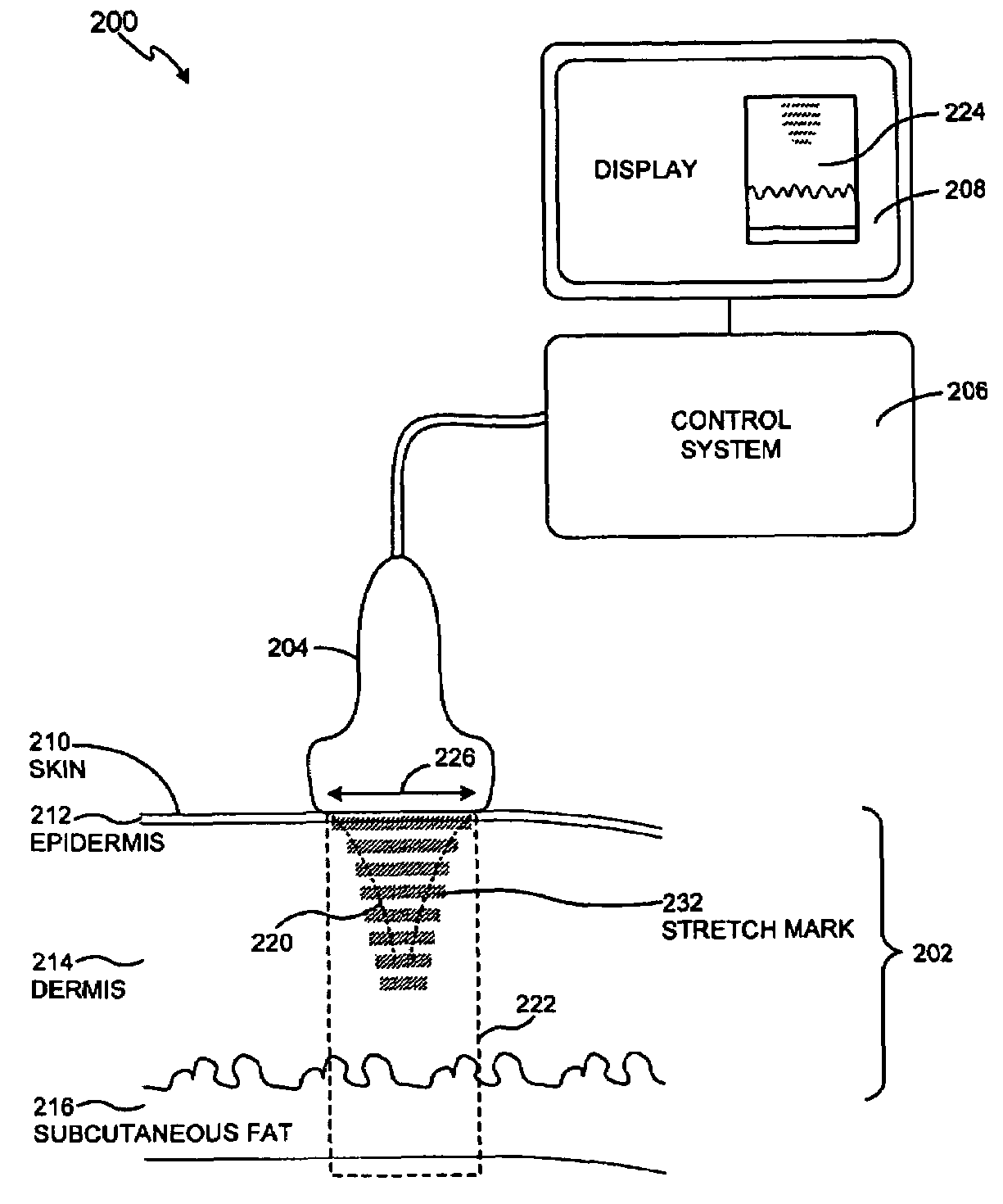 Method and system for treating stretch marks