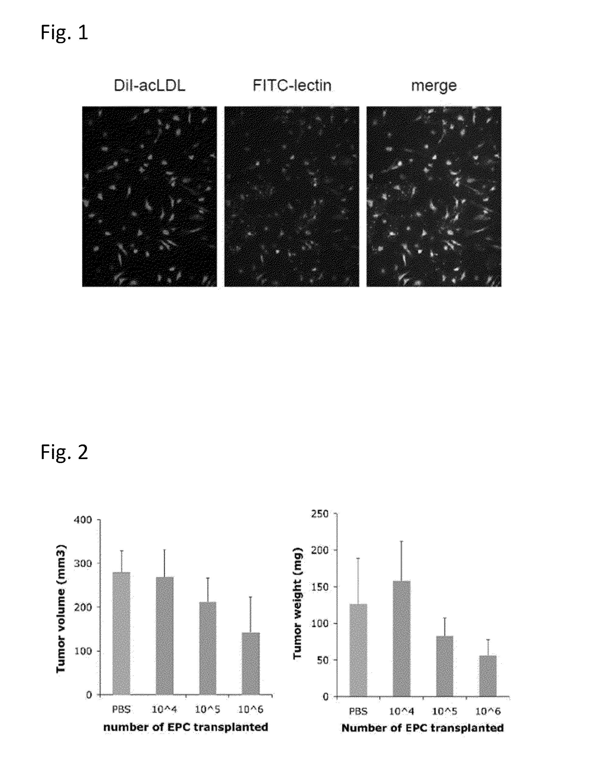 Anticancer therapy by transplanting vascular endothelial progenitor cells