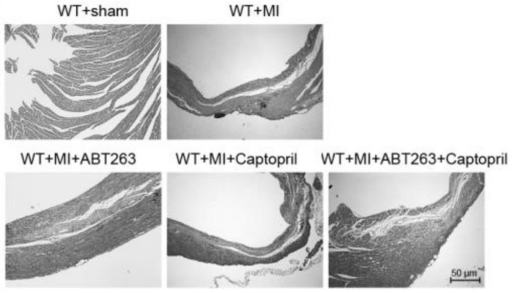 Application of ABT-263 combined angiotensin converting enzyme inhibitor and product of ABT-263 combined angiotensin converting enzyme inhibitor