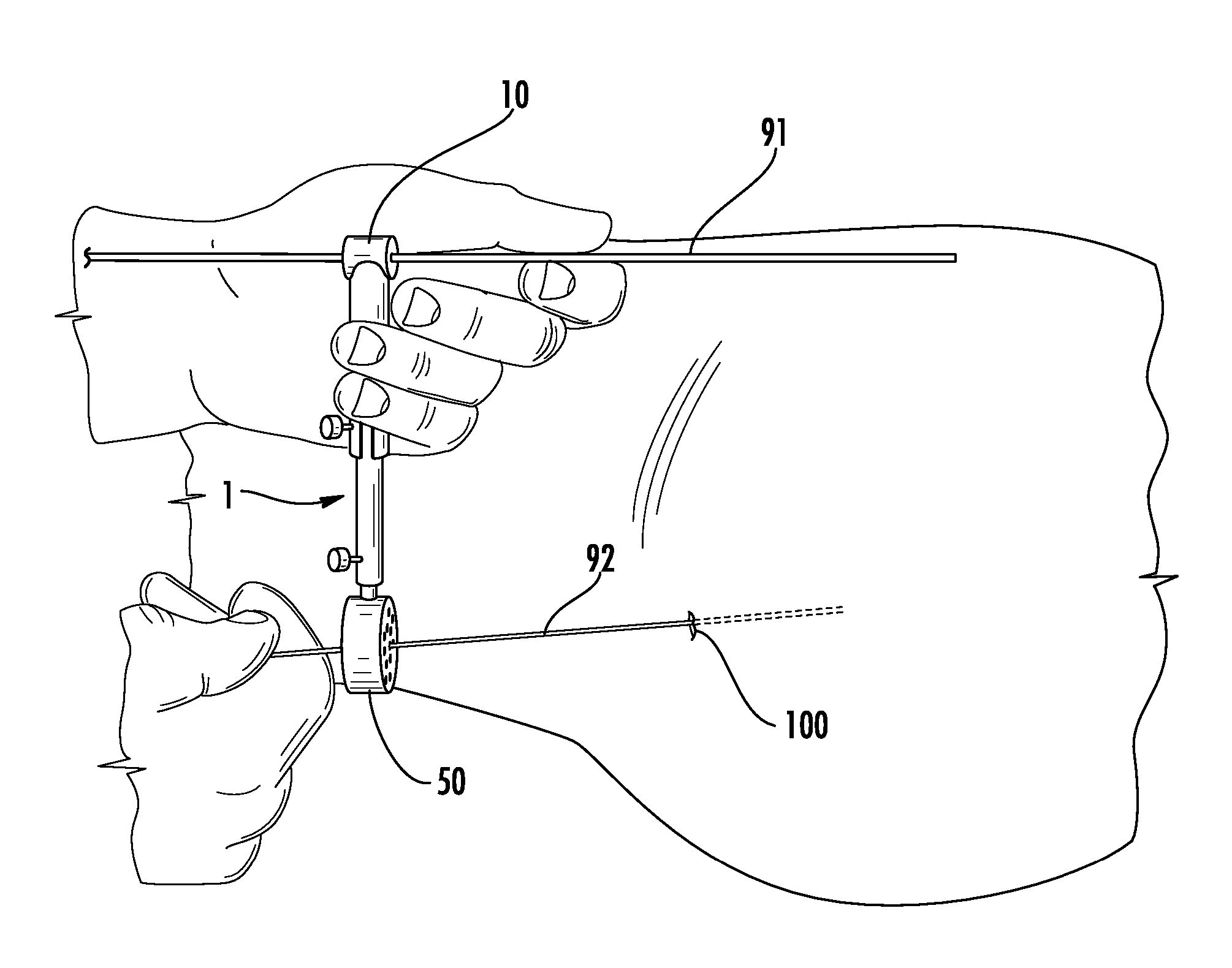 Guide pin placement for hip resurfacing