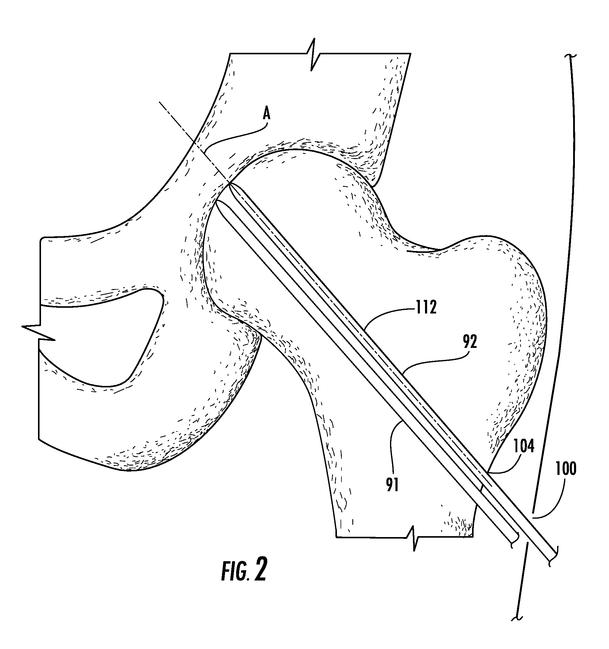 Guide pin placement for hip resurfacing