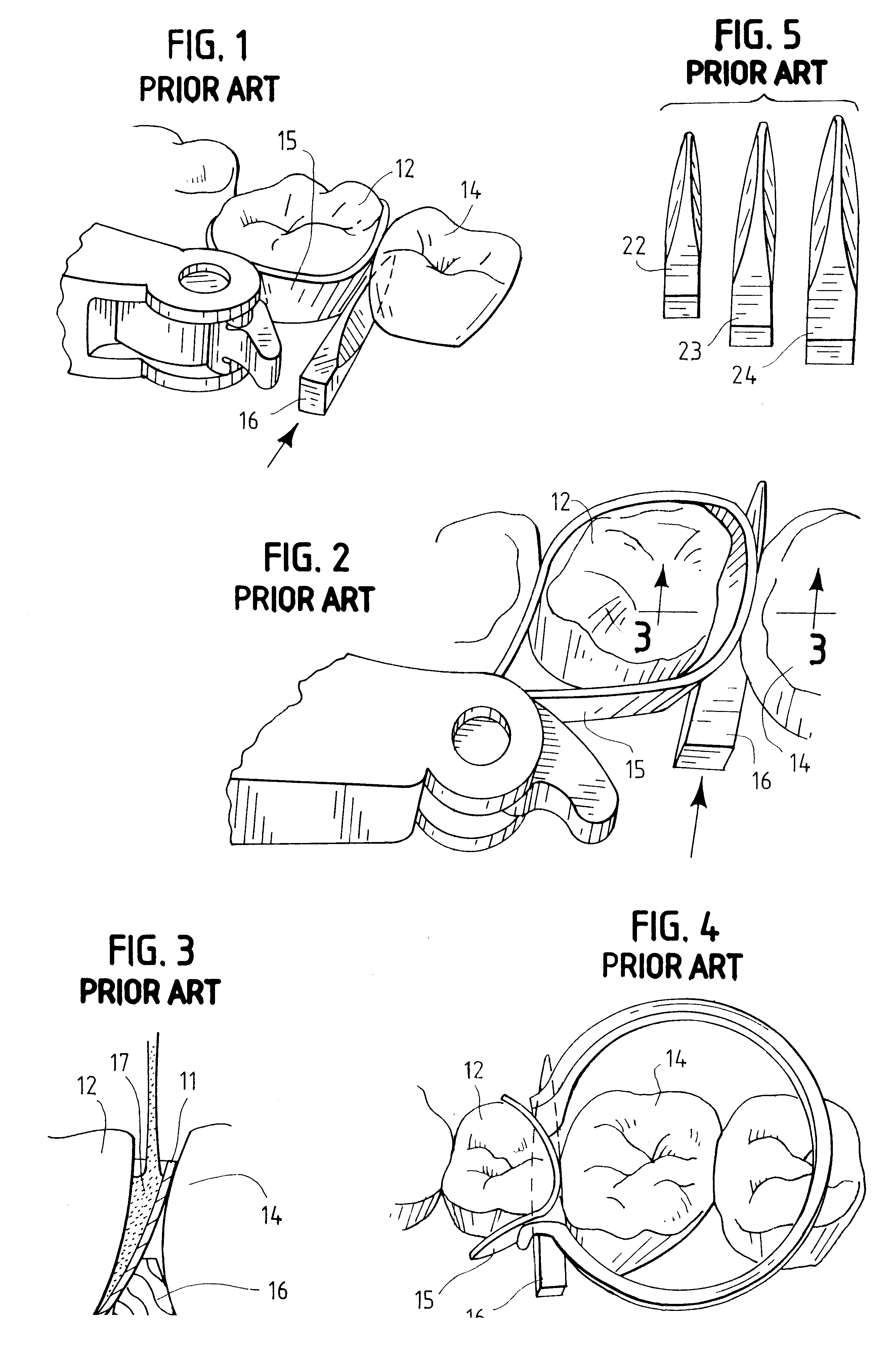 Elastic dental device