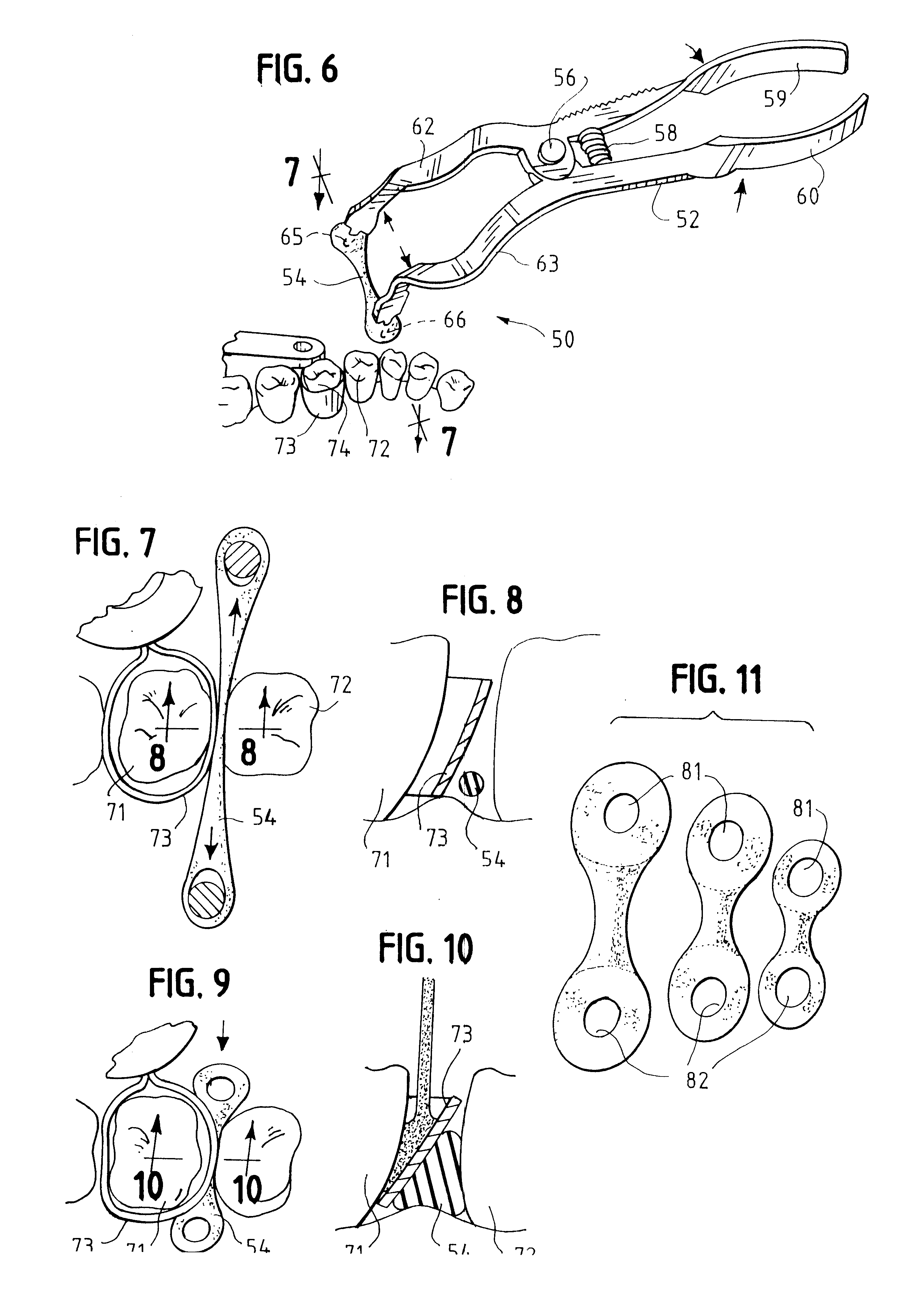 Elastic dental device