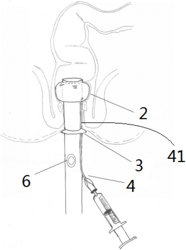 Indwelled anal tube and excrement collection device