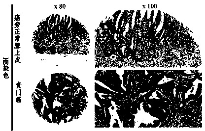 Gastric cancer prognosis predictive marker and application thereof