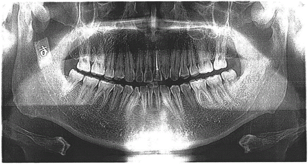 Frequency domain filtering-based CBCT (Cone Beam Computed Tomography) panoramic image enhancement method