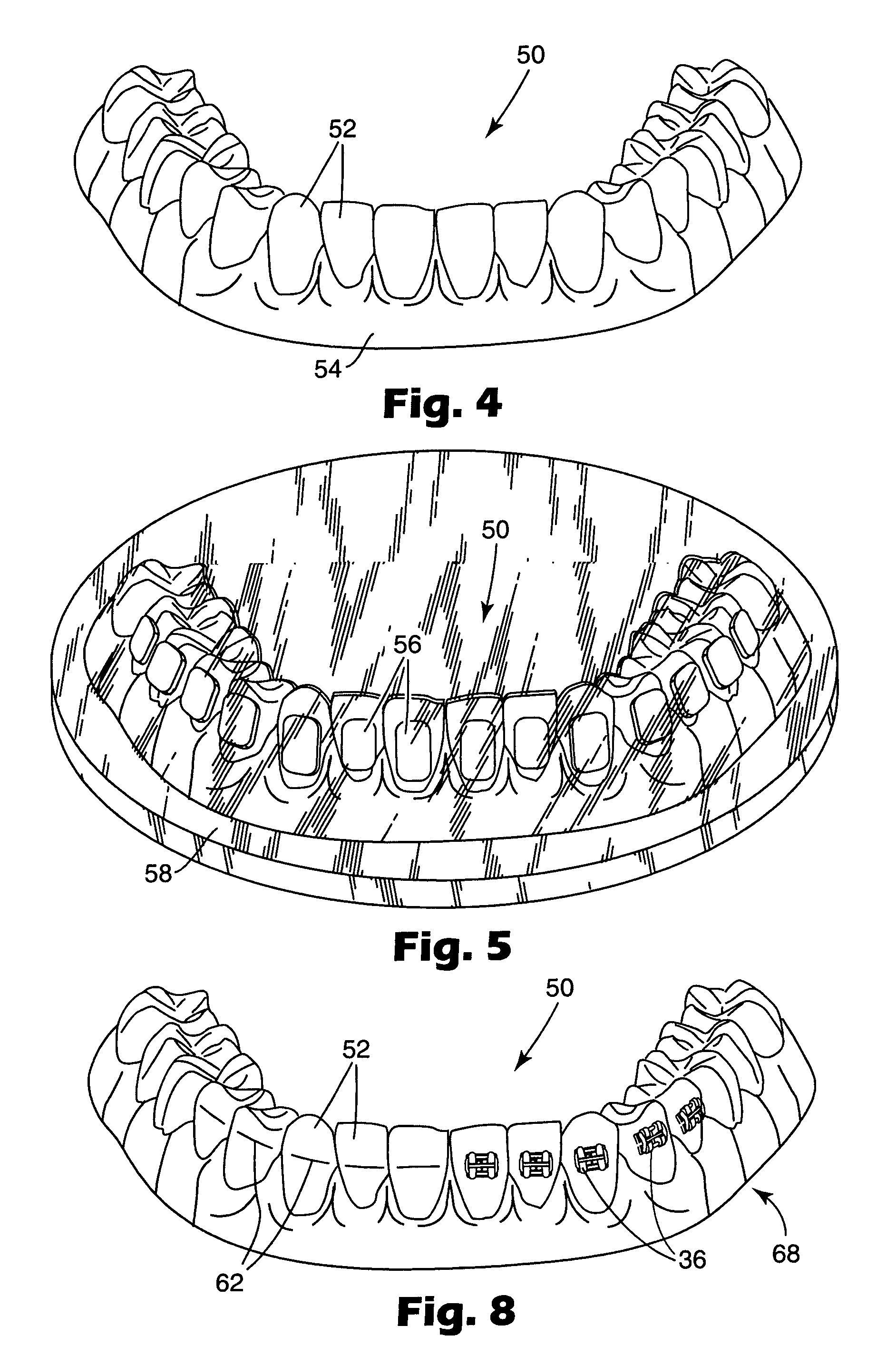 Apparatus for indirect bonding of orthodontic appliances and method of making the same