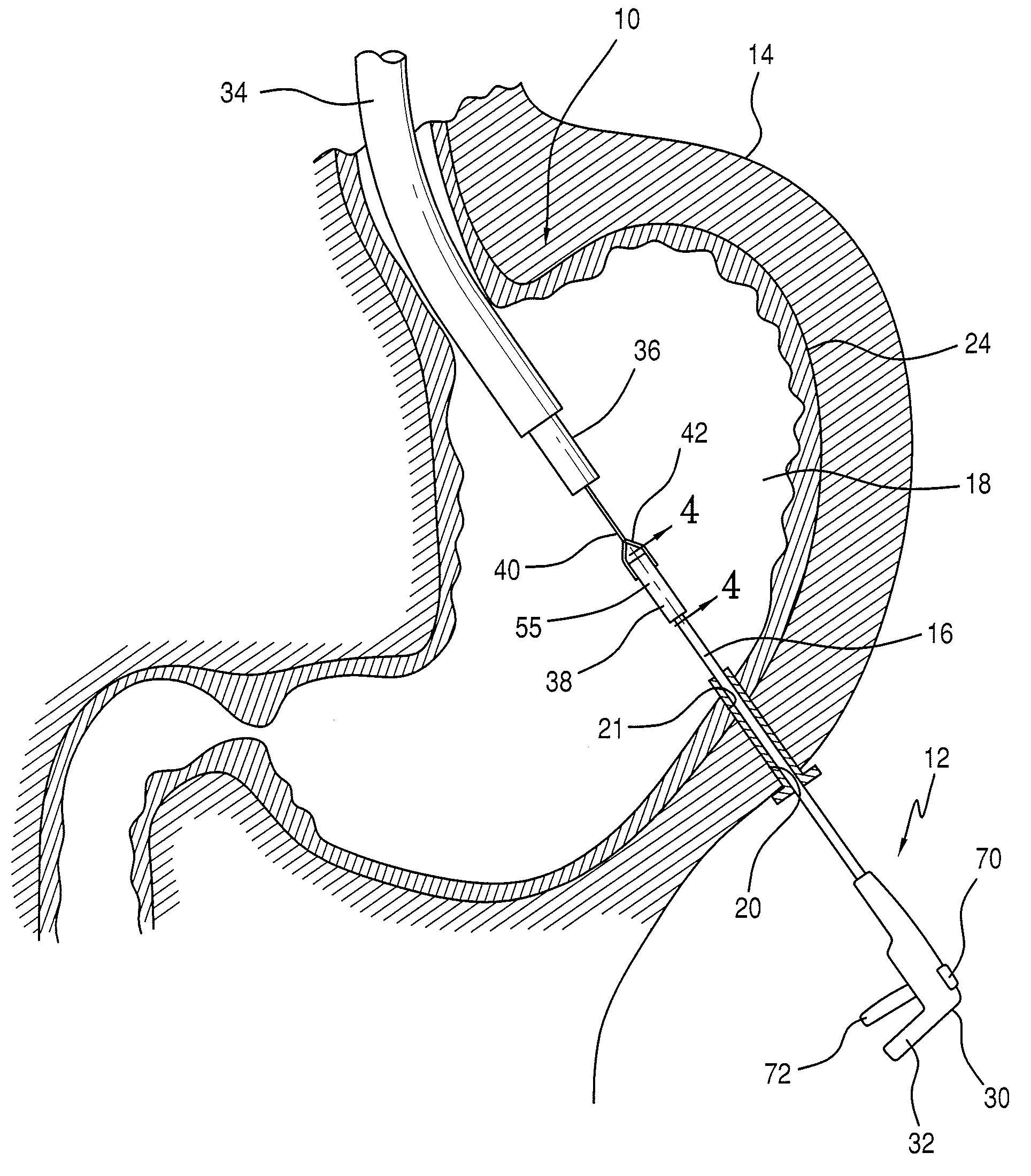 Hybrid laparoscopic-endoscopic surgical technique for delivering end effectors through a natural orifice