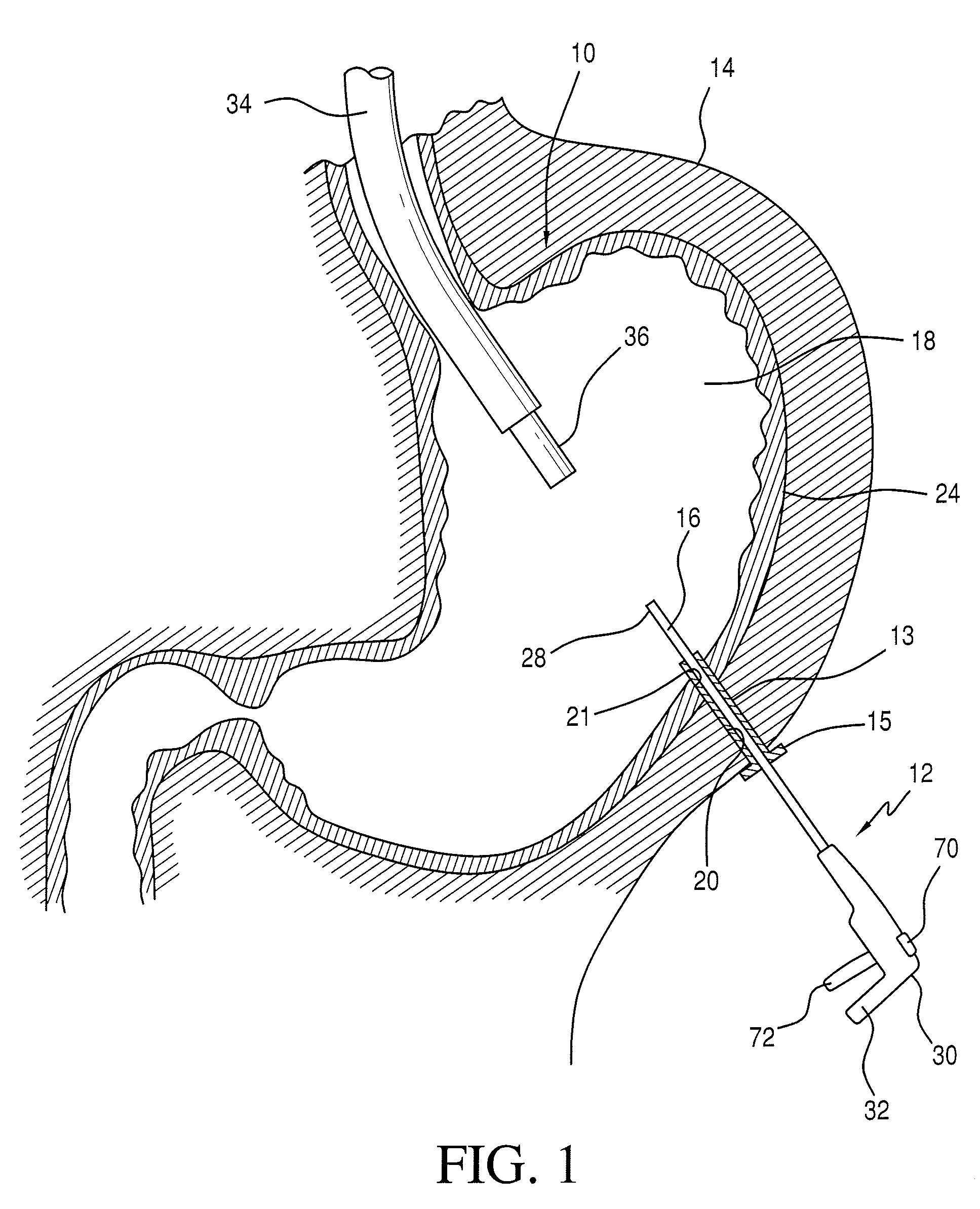 Hybrid laparoscopic-endoscopic surgical technique for delivering end effectors through a natural orifice