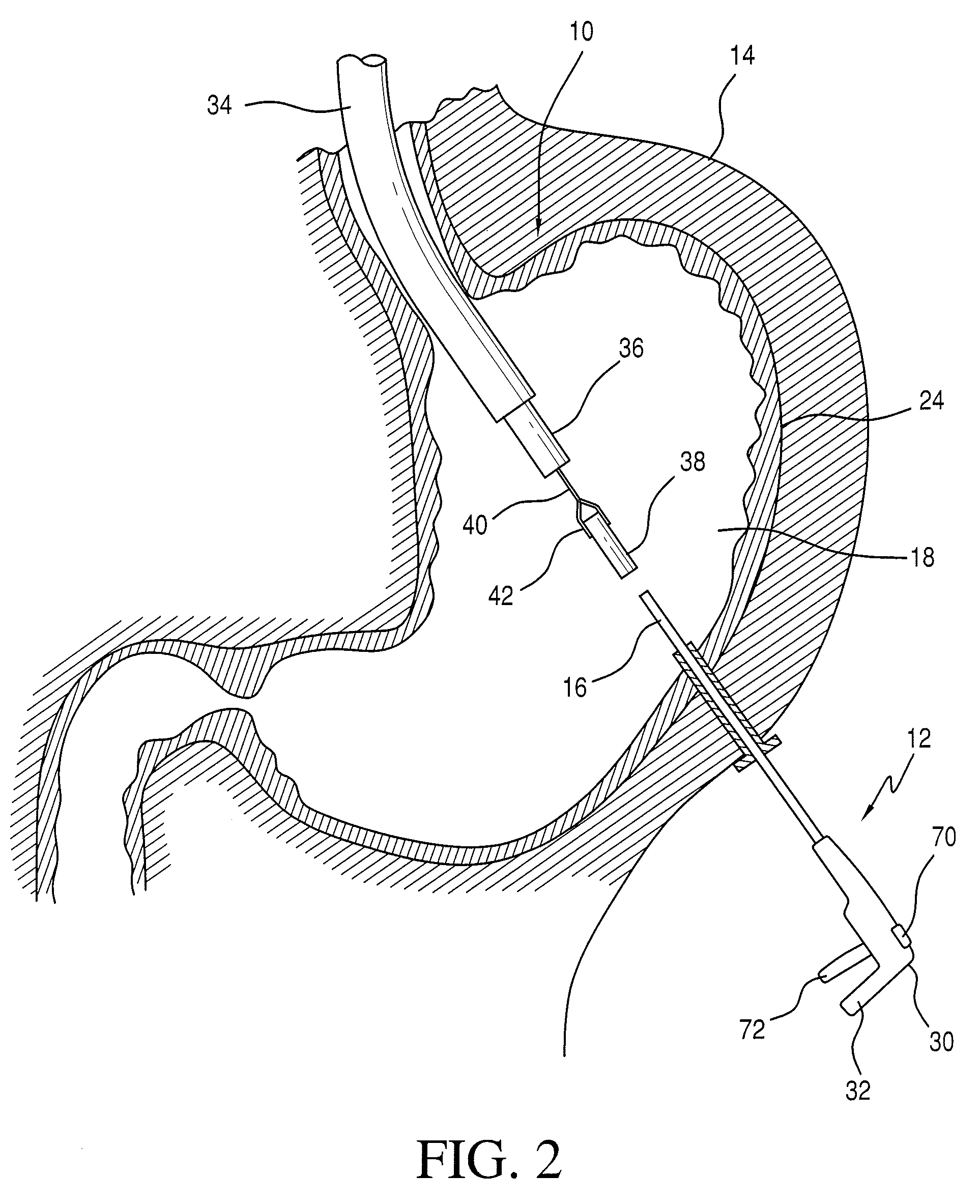 Hybrid laparoscopic-endoscopic surgical technique for delivering end effectors through a natural orifice