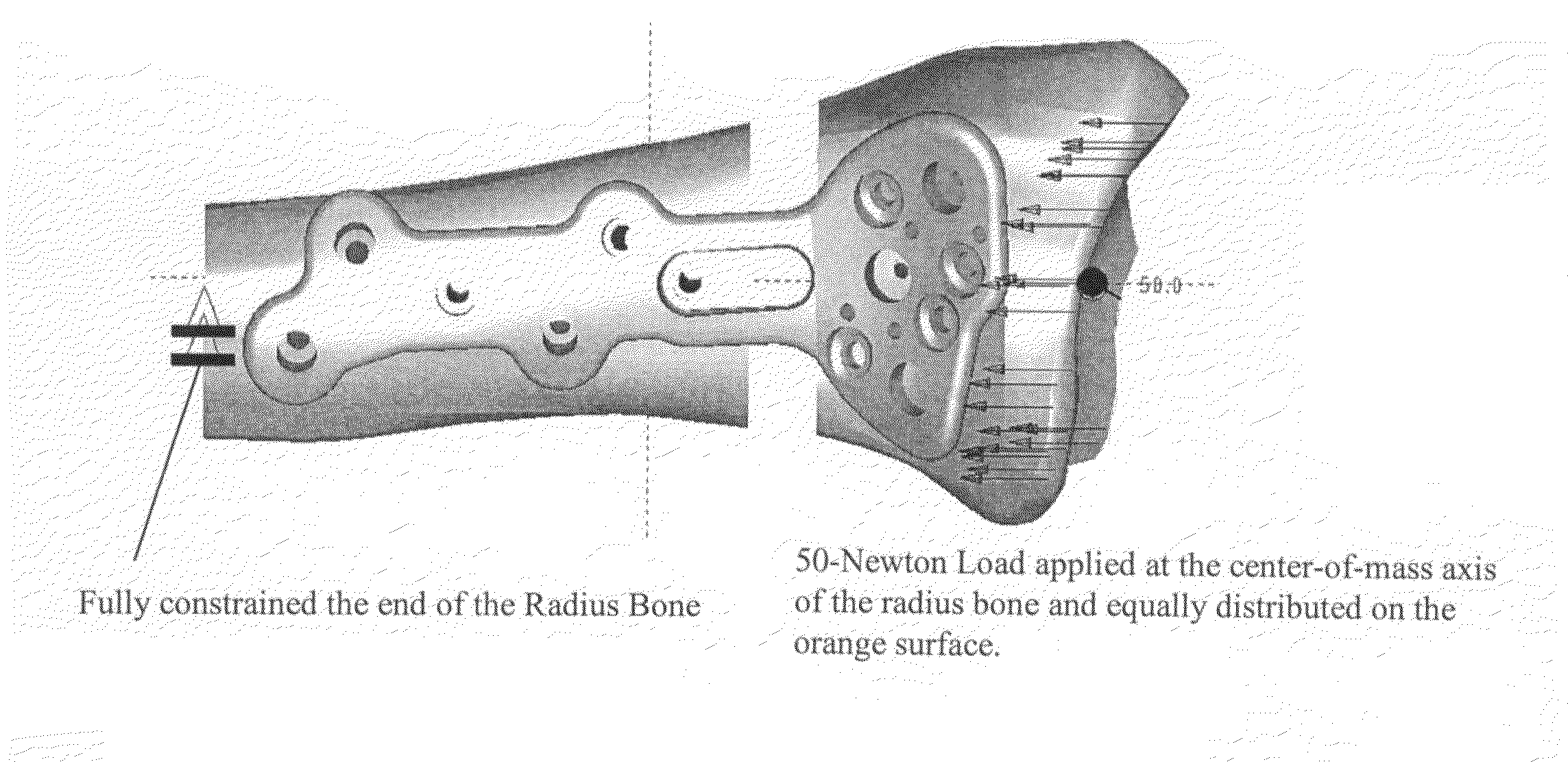 Method of making orthopedic implants and the orthopedic implants