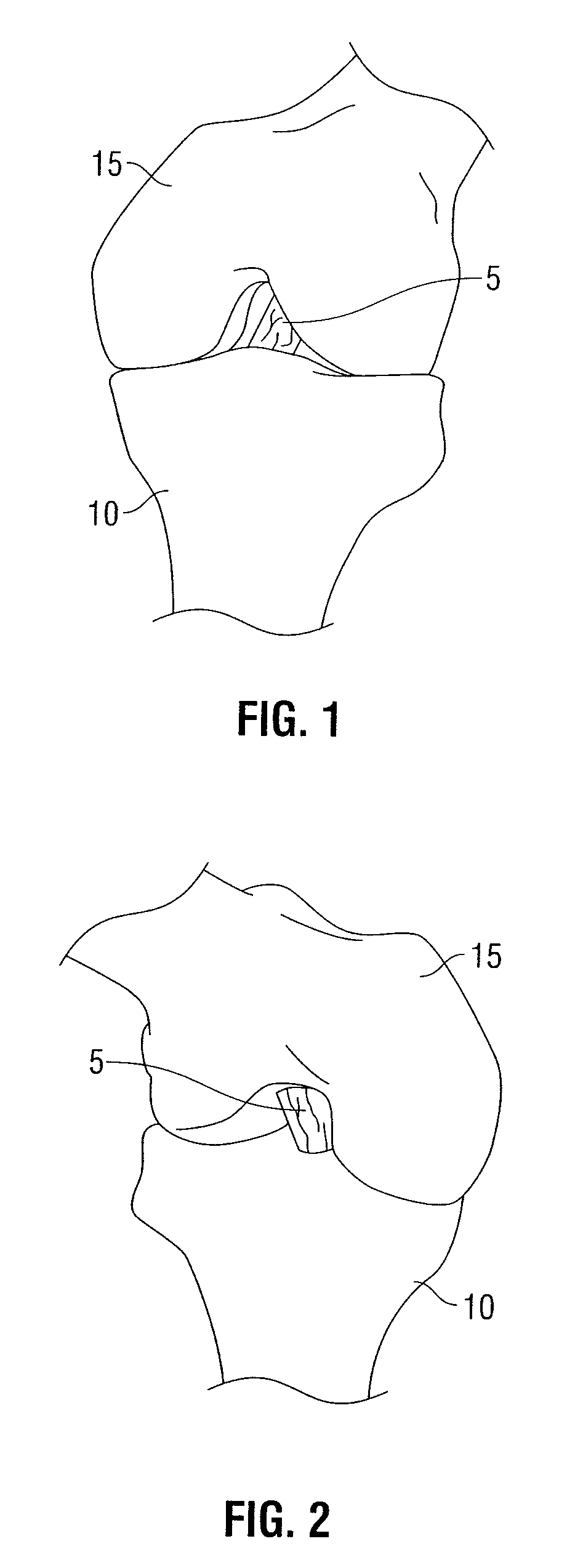 Femoral guide for ACL repair having multiple lumen