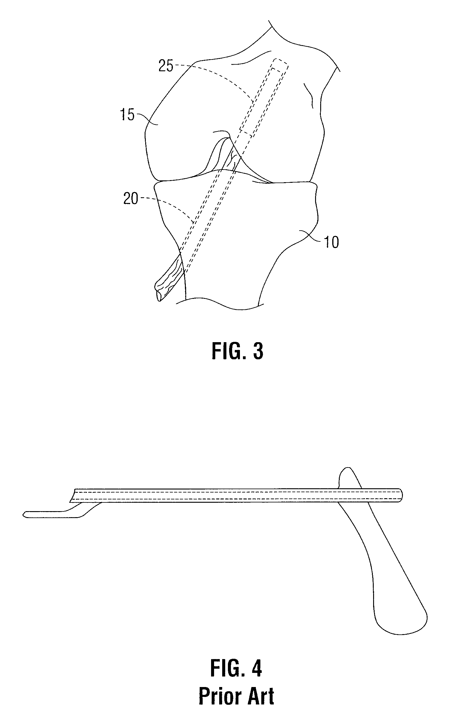 Femoral guide for ACL repair having multiple lumen