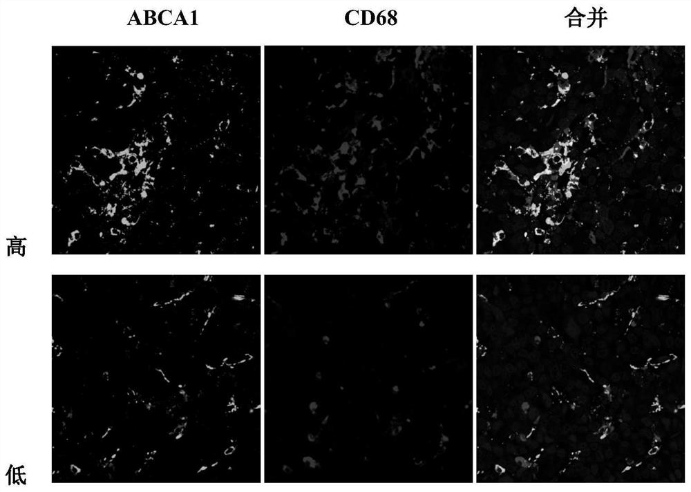 Application of ABCA1 and CD68 as prognosis markers in preparation of liver cancer prognosis prediction kit