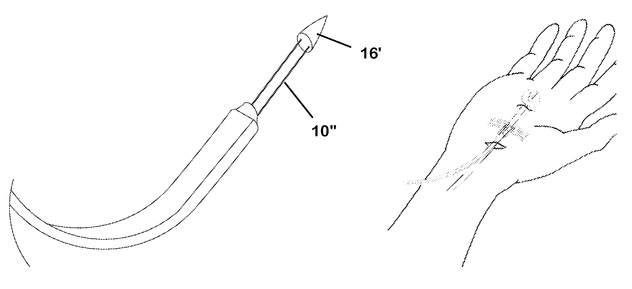 Sling blade transection of the transverse carpal ligament