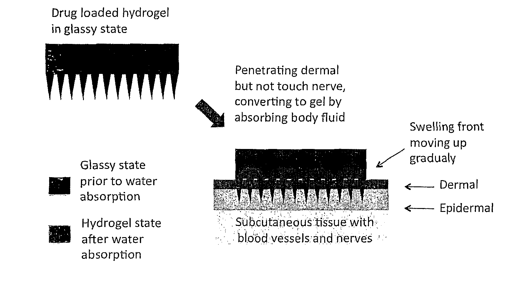 Phase-transition polymeric microneedles