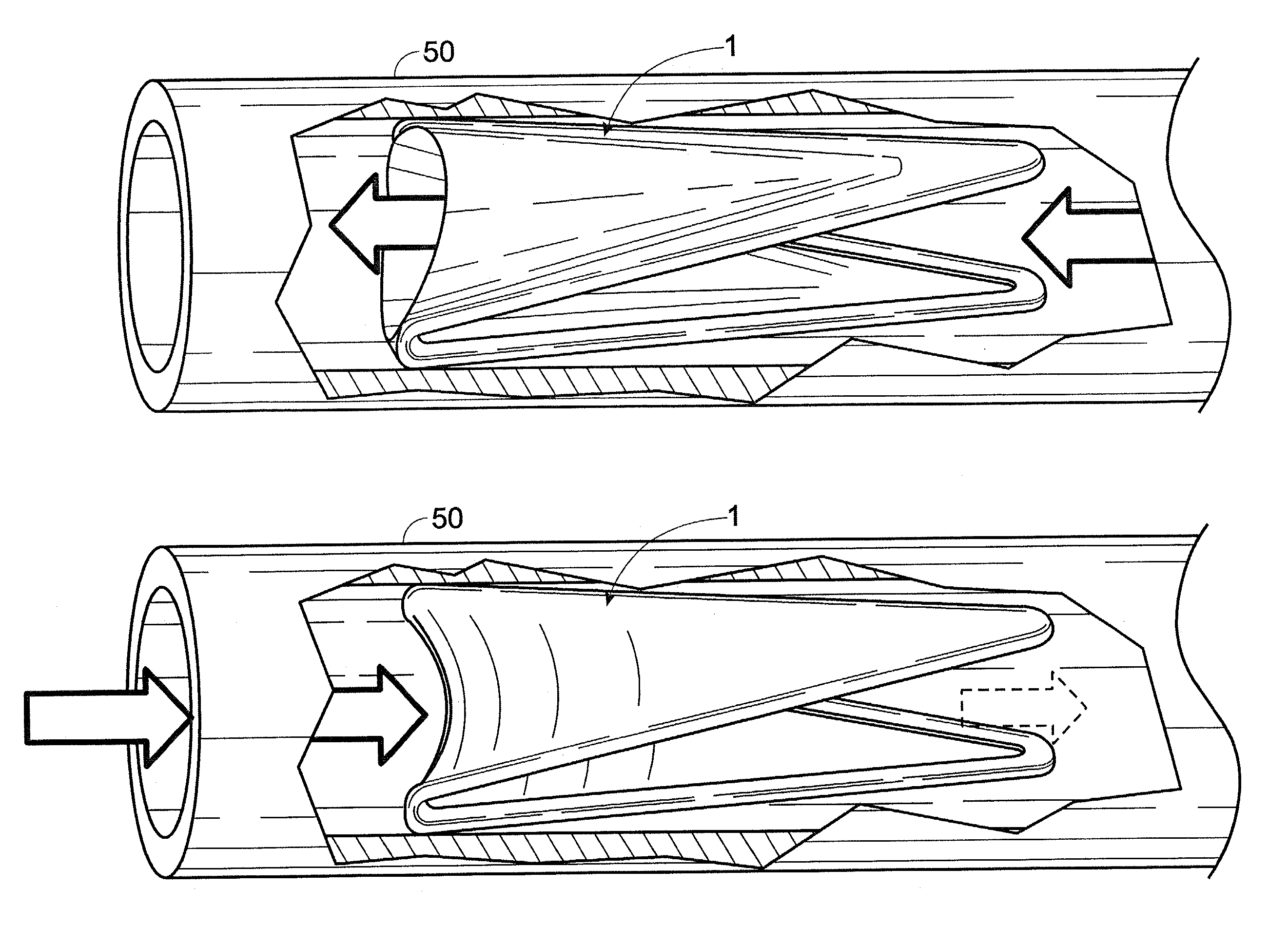 Bioprosthesis and method for suturelessly making same