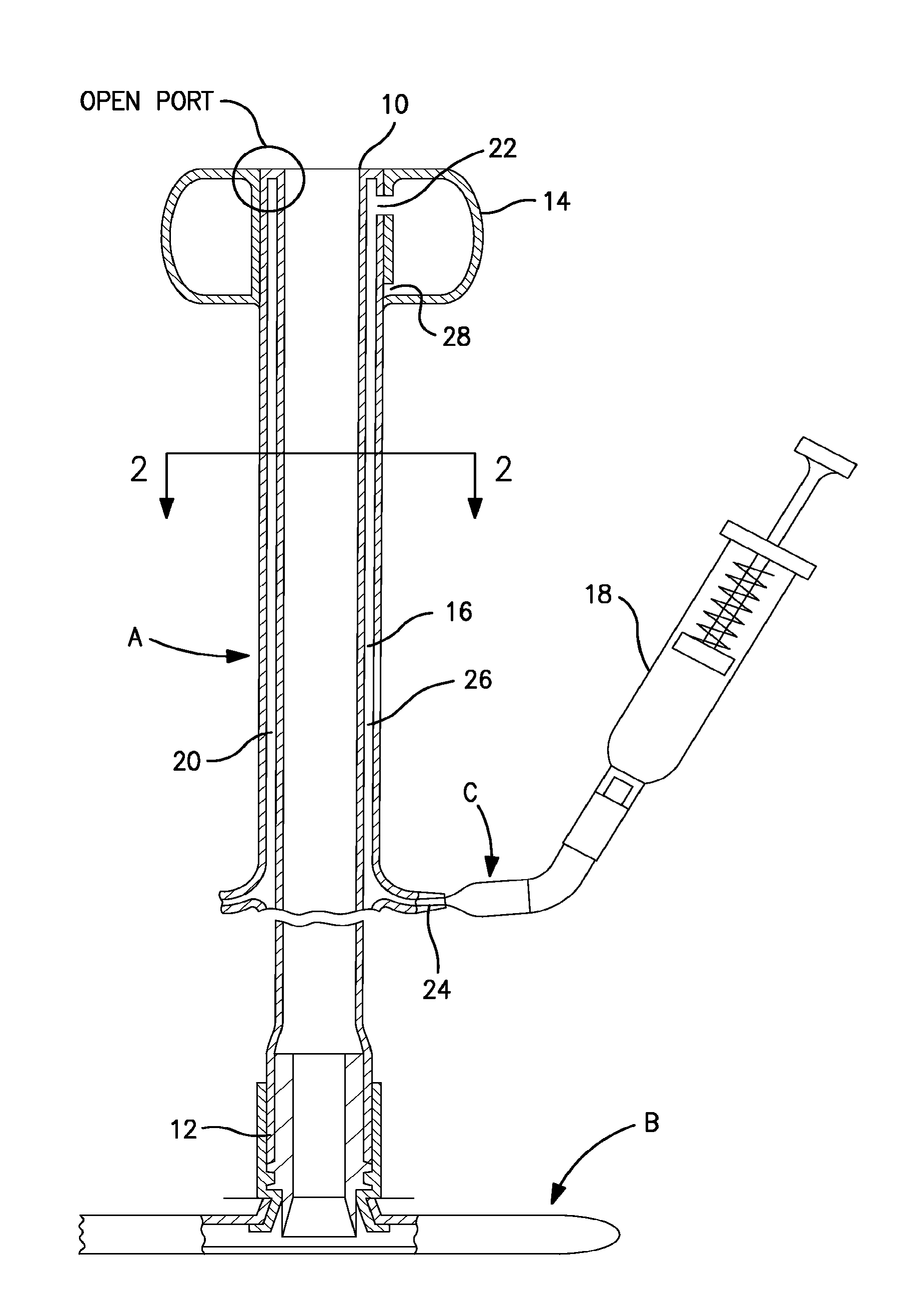 Apparatus for preventing over inflation of the retention balloon in medical catheters and airway devices