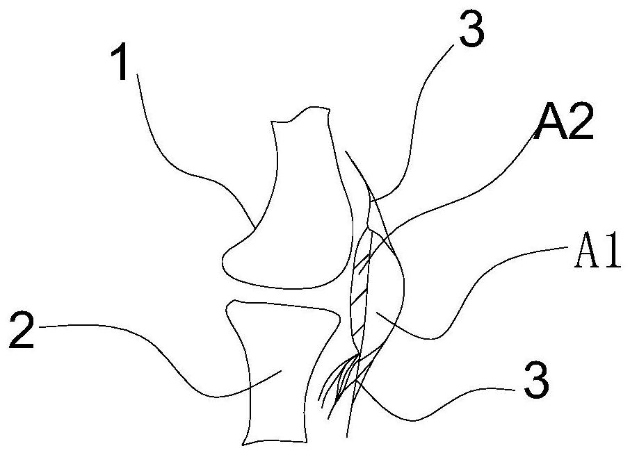 Design method of a patella prosthesis