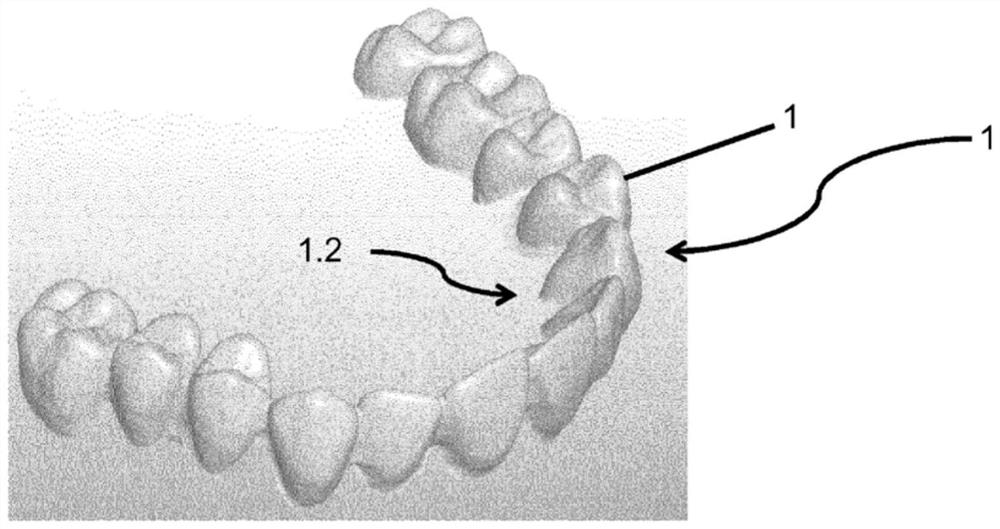 Method of manufacture of partial or complete dentures and dentures obtained according to this method