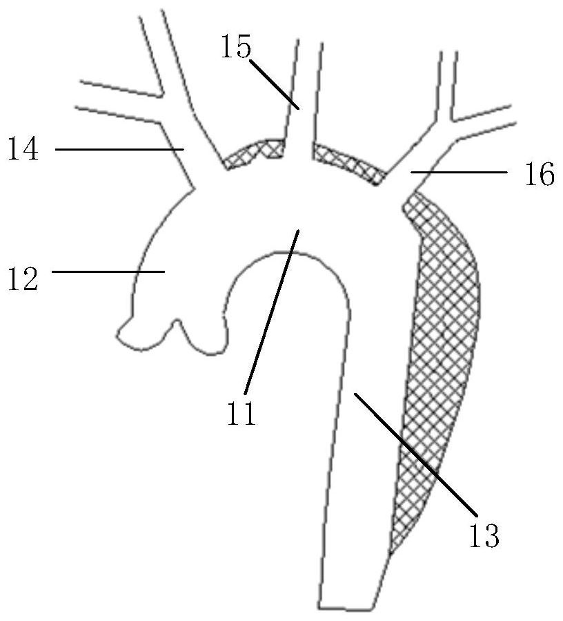 Covered stent