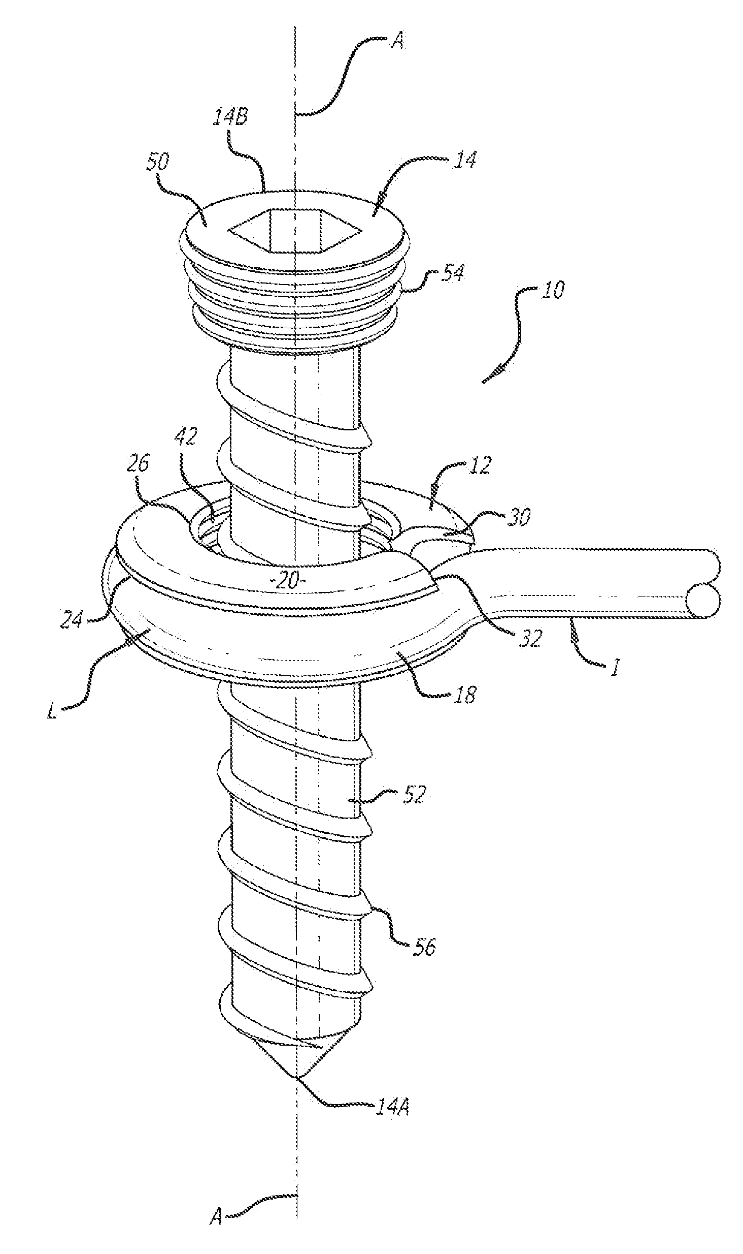 Screw fixation system