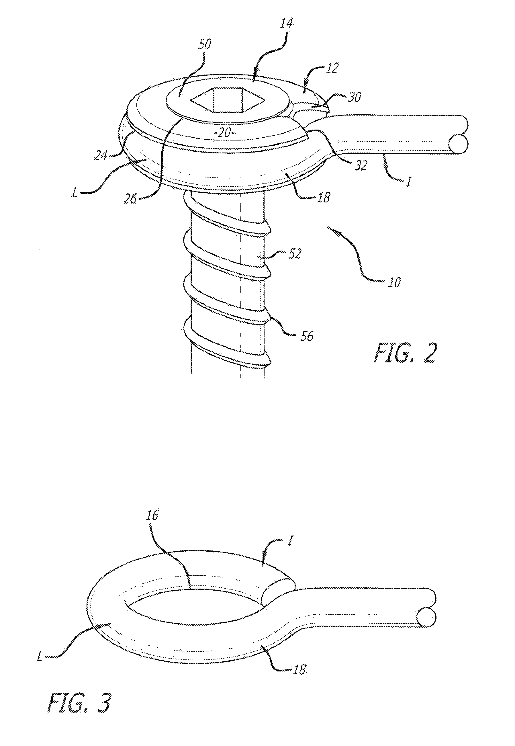 Screw fixation system