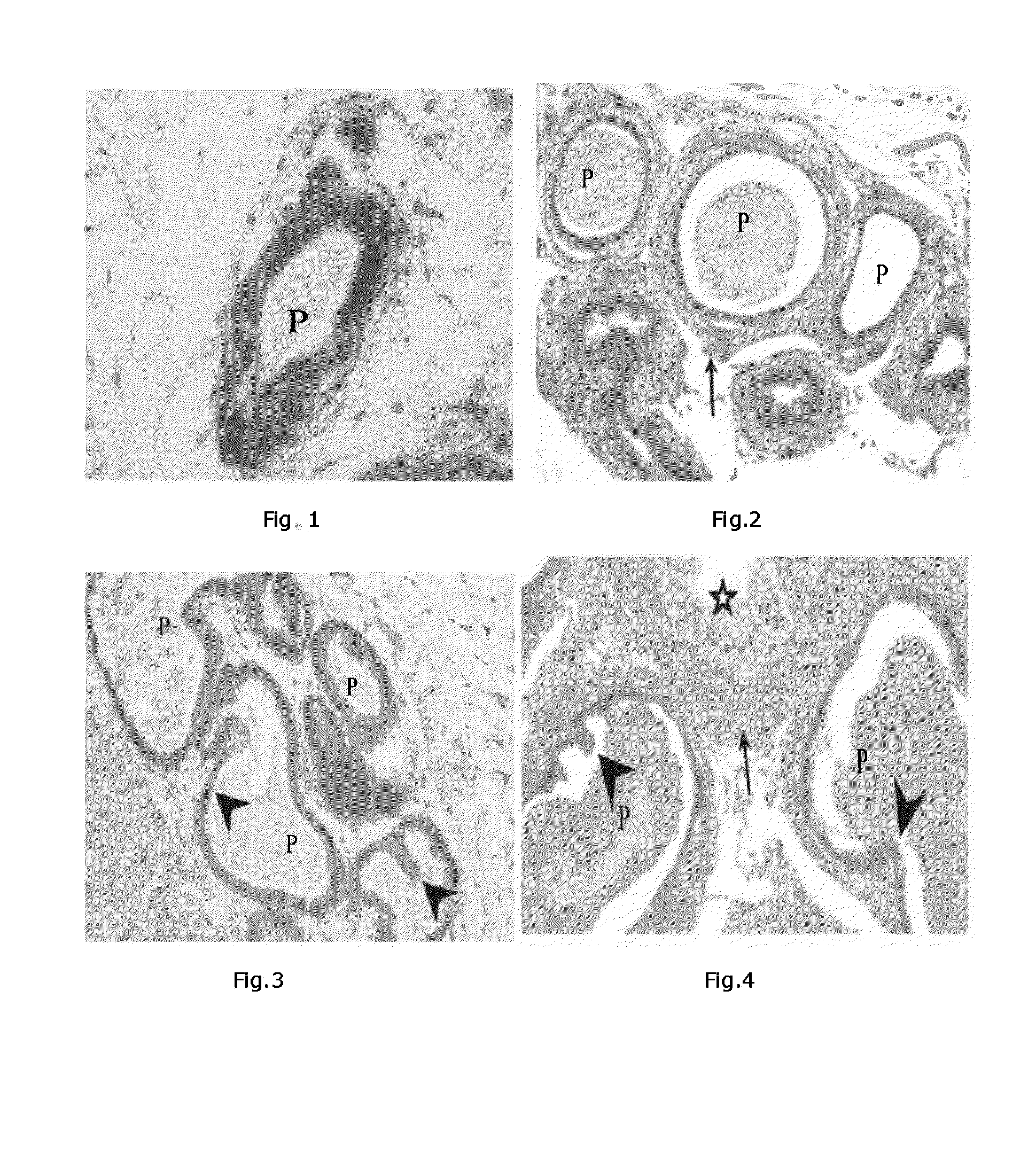 Methods for therapeutic treatment of benign prostatic hypertrophy (BPH)