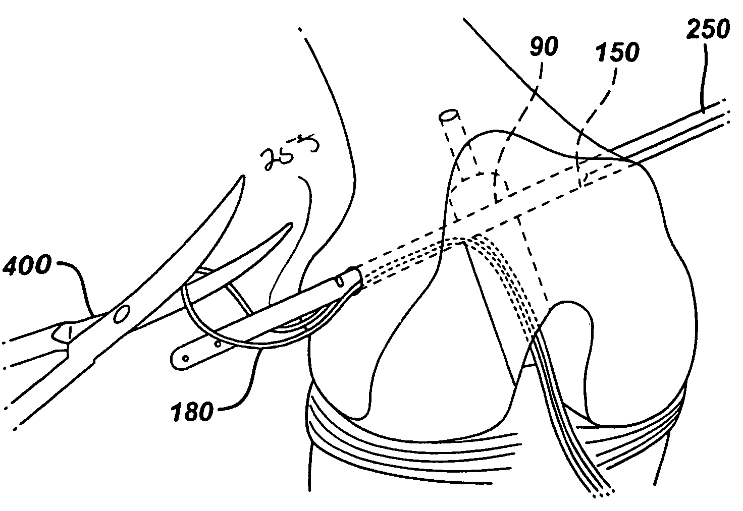 Method of replacing an anterior cruciate ligament in the knee