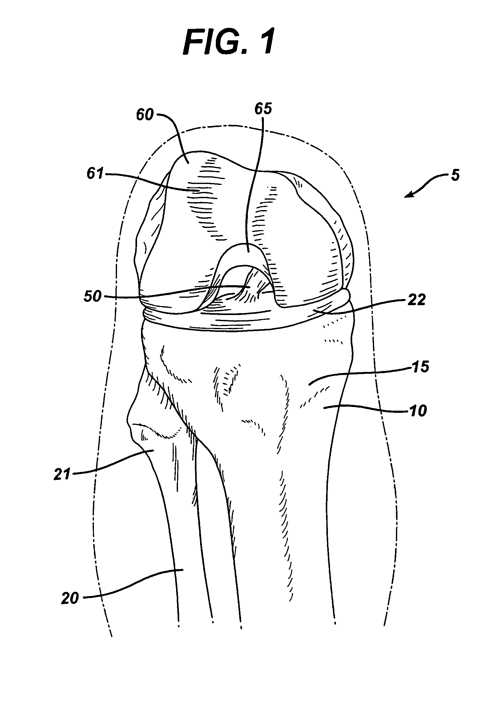 Method of replacing an anterior cruciate ligament in the knee